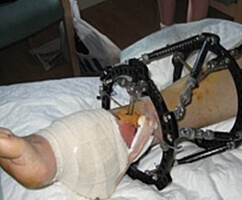 Amazing Stem Cell Treatment Saves British Man’s Leg