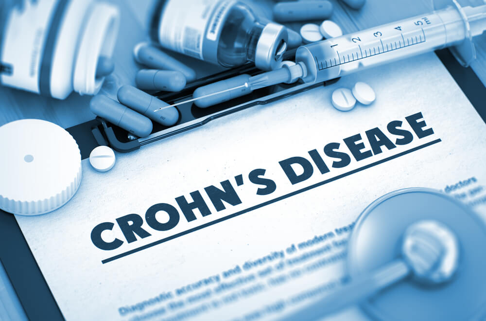 UK based clinical trial to treat Crohn’s with stem cells