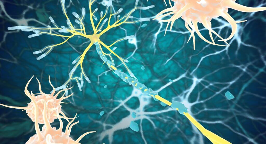 Early Insight Into Placenta Stem Cell Therapy for Multiple Sclerosis