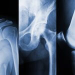 Shoulder, hip and knee joints x-ray illustration
